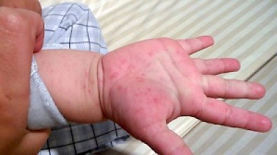 Chicken Pox in Yucatan Mexico <a href=></a>