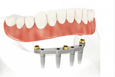 All on Four Implants <a href=></a>